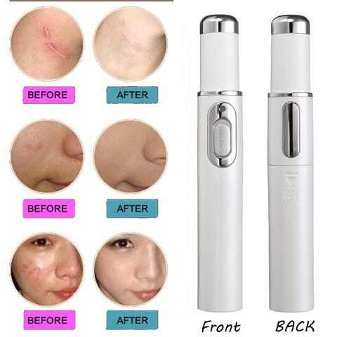 Laser Pen for Acne Therapy or Wrinkle Removal ...